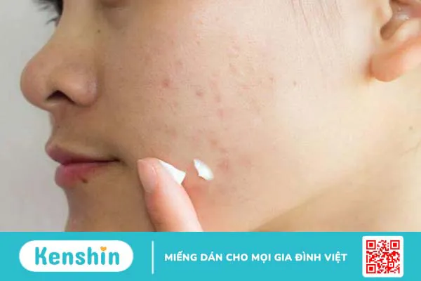 Trị sẹo rỗ đáy vuông hiệu quả - Nỗi băn khoăn của nhiều người 1