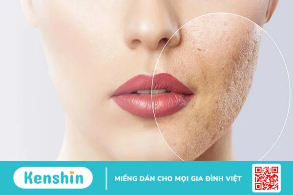 Trị sẹo rỗ đáy vuông hiệu quả - Nỗi băn khoăn của nhiều người 2