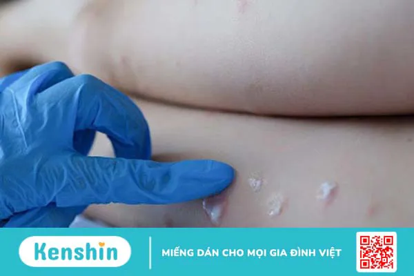 Triệu chứng và cách phòng bệnh đậu mùa khỉ4