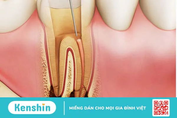 Trồng răng có cần lấy tủy không? 2