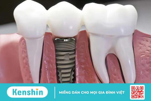 Trụ DIO Implant có tốt hay không? 1