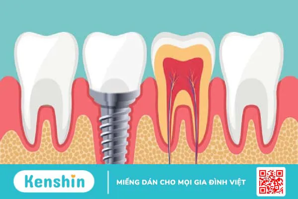 Trụ DIO Implant có tốt hay không? 2