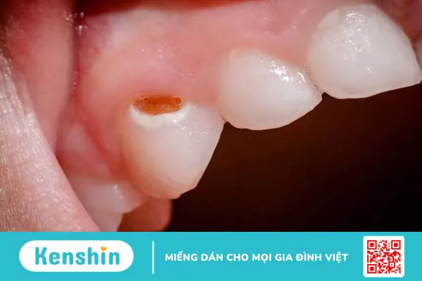 Tại sao đôi lúc lại cần trám răng sữa cho con? 1