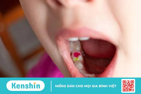 Tại sao đôi lúc lại cần trám răng sữa cho con? 2