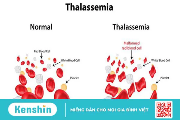 Giải đáp: Bệnh Thalassemia là gì? Tuổi thọ của người bị bệnh thalassemia thể nhẹ là bao lâu?1