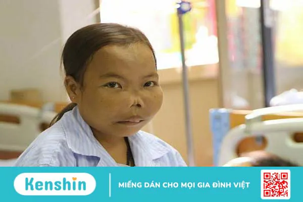 Giải đáp: Bệnh Thalassemia là gì? Tuổi thọ của người bị bệnh thalassemia thể nhẹ là bao lâu? 2