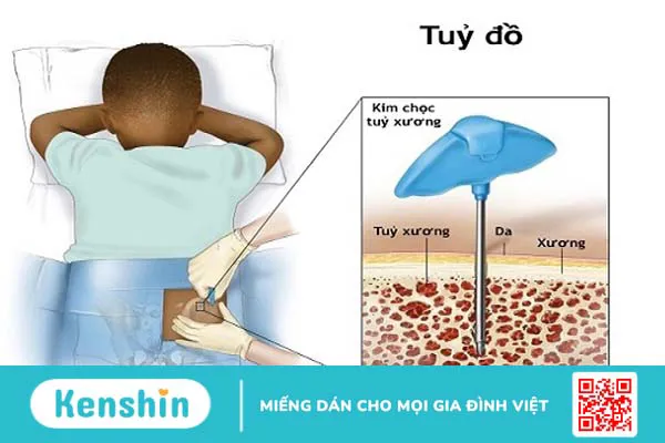 Mục đích thực hiện tủy đồ và sinh thiết tủy và quy trình thực hiện 1