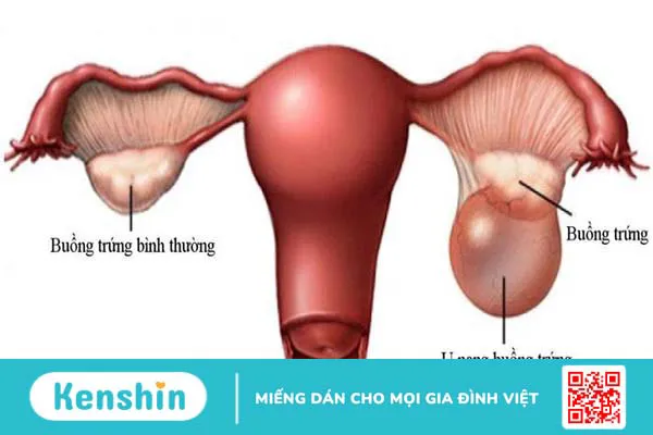 U nang buồng trứng được phân chia thành hai loại chính là u nang thực thể và u nang cơ năng