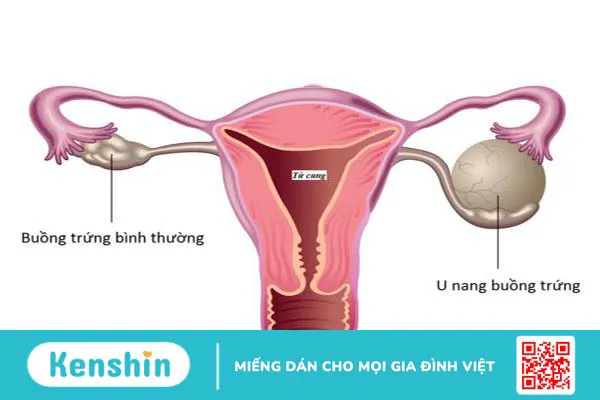 U nang nhầy buồng trứng 1