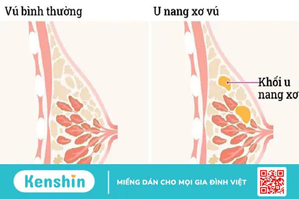 U nang vú là bệnh gì?? U nang vú kiêng ăn gì? 1