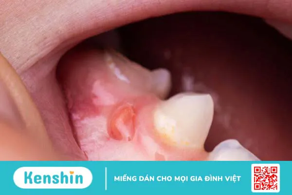 U răng phức hợp: Nguyên nhân, triệu chứng và điều trị 1