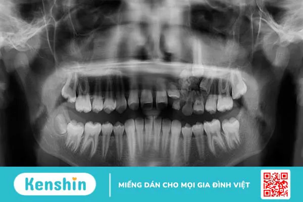 U răng phức hợp: Nguyên nhân, triệu chứng và điều trị 3