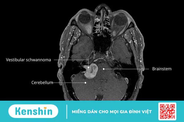 U schwannoma: Nguyên nhân, triệu chứng, chẩn đoán và phương pháp điều trị 1