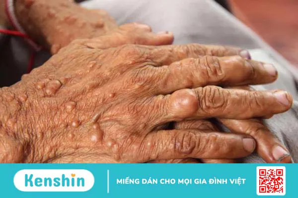 U thần kinh ngoại biên: Một số nguyên nhân và triệu chứng đáng lo ngại của bệnh 1