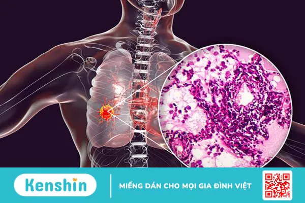 Ung thư biểu mô tuyến phổi: Triệu chứng và cách điều trị 1