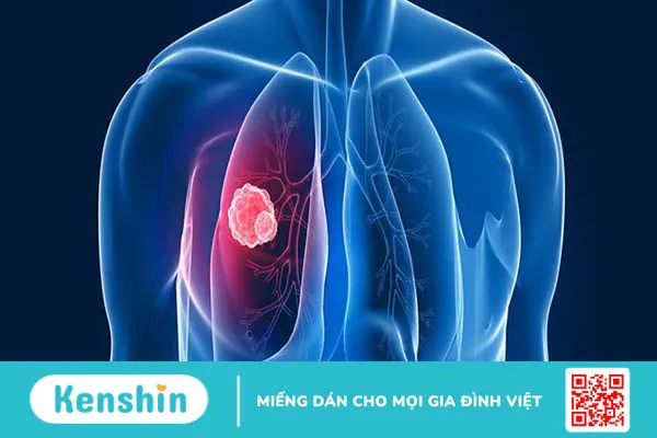 Ung thư biểu mô tuyến phổi: Triệu chứng và cách điều trị 2