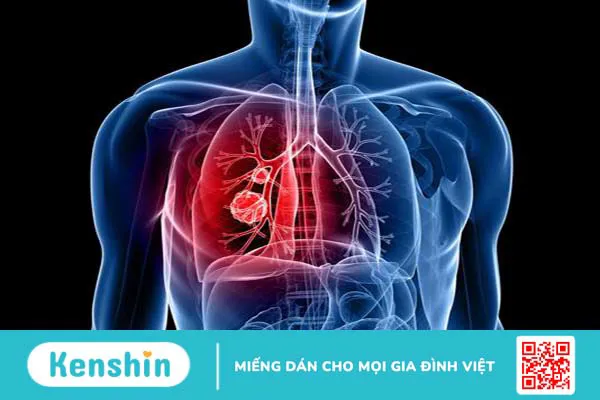 Ung thư biểu mô tuyến phổi: Triệu chứng và cách điều trị 3