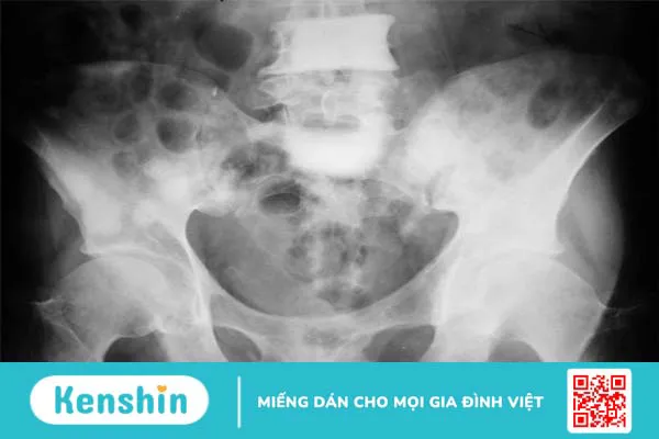 Tìm hiểu về ung thư di căn xương1