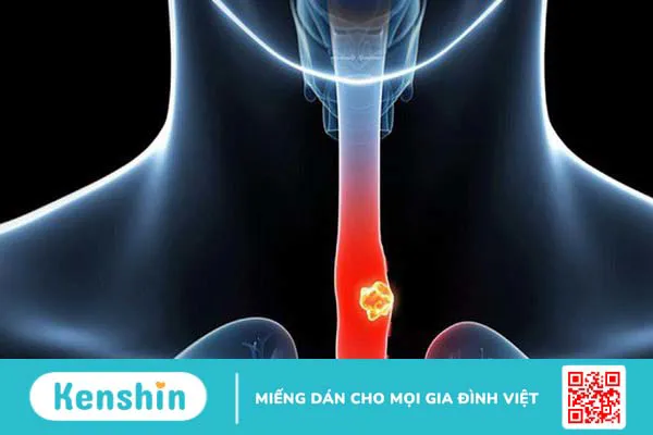 Ung thư thực quản giai đoạn 0 có nguy hiểm không? 2