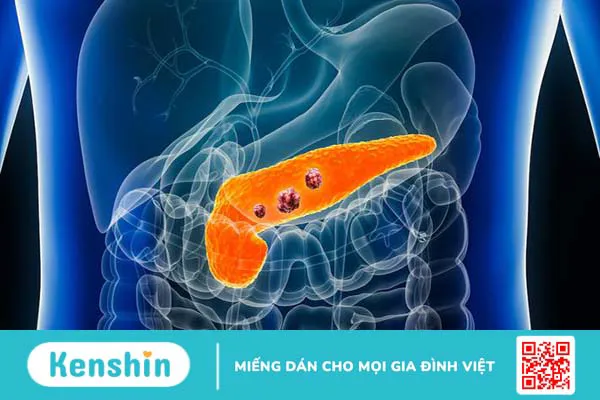 Ung thư tuyến tụy di căn gan và thông tin cần biết 1