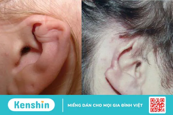 Vành tai bé bị sưng đỏ là bệnh gì