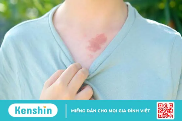 Vết bớt là gì? Chúng có gây hại không? 1