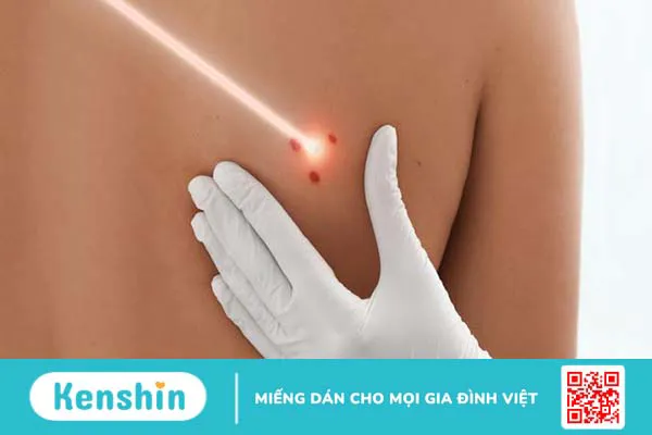 Vết bớt là gì? Chúng có gây hại không? 4