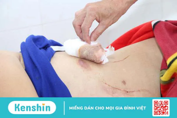 Vi khuẩn ăn thịt người có ở đâu? Thời điểm có nguy cơ cao mắc bệnh nhất 3