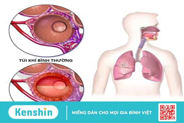 Vi khuẩn Klebsiella Pneumoniae gây ra những triệu chứng gì?