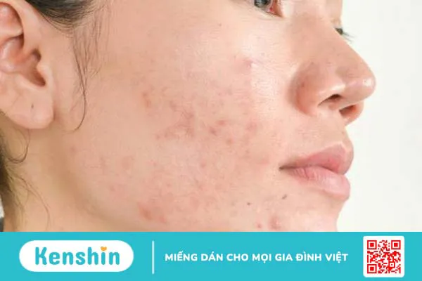 Vi khuẩn P Acnes là gì? Cách tiêu diệt vi khuẩn P Acnes 1