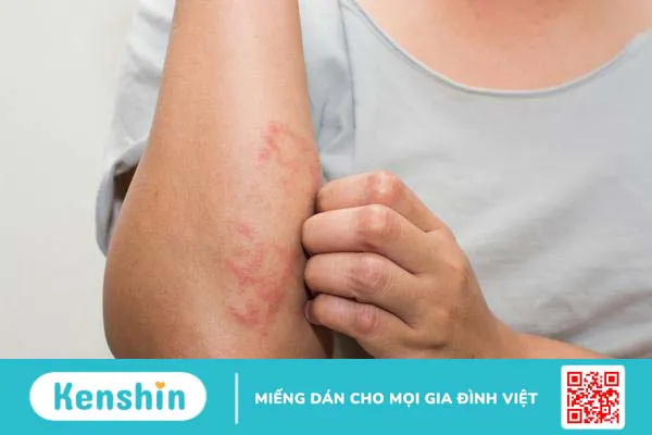 Vi khuẩn tụ cầu gây bệnh gì? Có nguy hiểm không 2