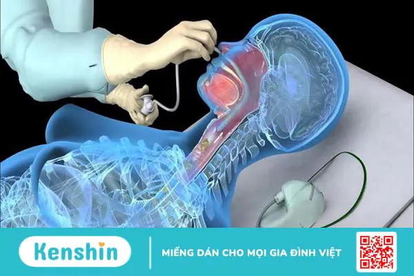 Vì sao cần phải hút xoang mũi? Cách thức thực hiện1