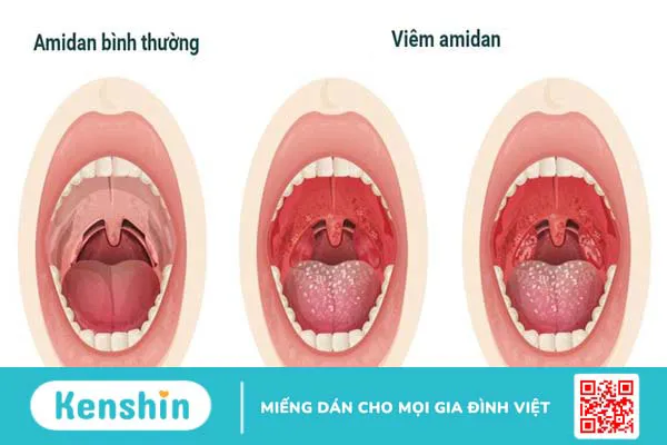 Amidan đảm nhiệm vai trò miễn dịch, nó là cơ quan bảo vệ của cơ thể khỏi các tác nhân gây bệnh xâm nhập vào các cơ quan hô hấp và tiêu hóa