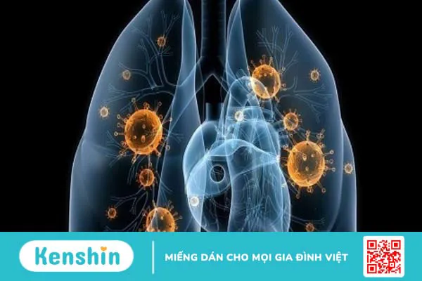 Viêm dây thần kinh cấp tính nguyên phát: Nguyên nhân, triệu chứng và điều trị 1