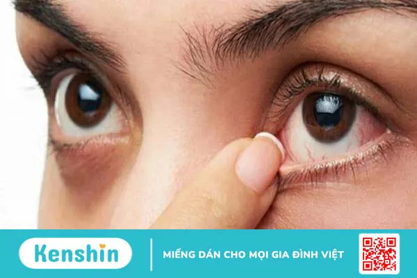 Viêm gai thị thần kinh: Nguyên nhân, biểu hiện, phương pháp chẩn đoán và điều trị 2