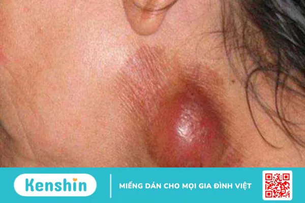 Viêm hạch là gì? Nguyên nhân, triệu chứng và phương pháp điều trị 1