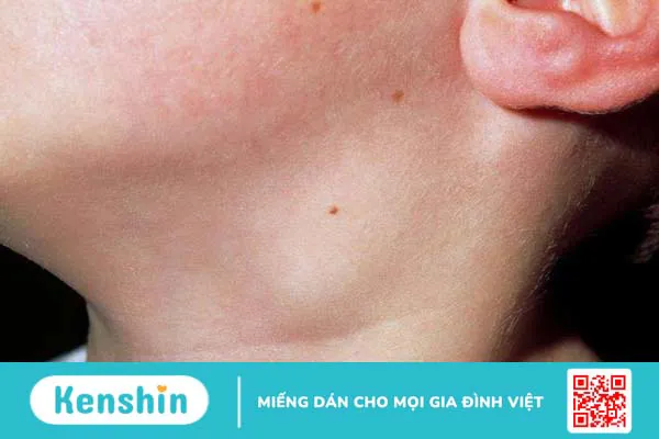 Viêm hạch là gì? Nguyên nhân, triệu chứng và phương pháp điều trị 3