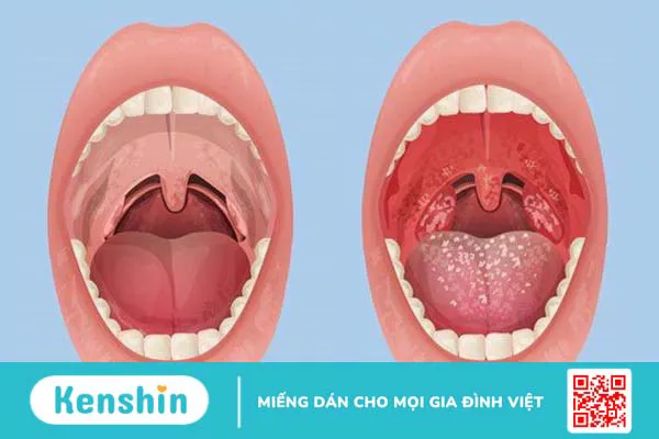 Viêm họng do virus: Triệu chứng thường gặp và cách điều trị hiệu quả