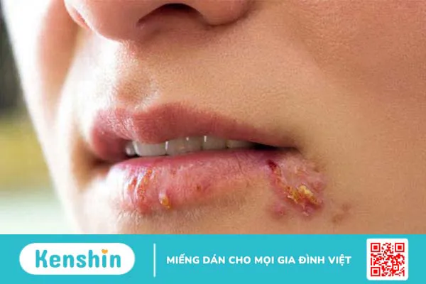 Viêm mép môi là bệnh gì? Cách điều trị như thế nào? 1