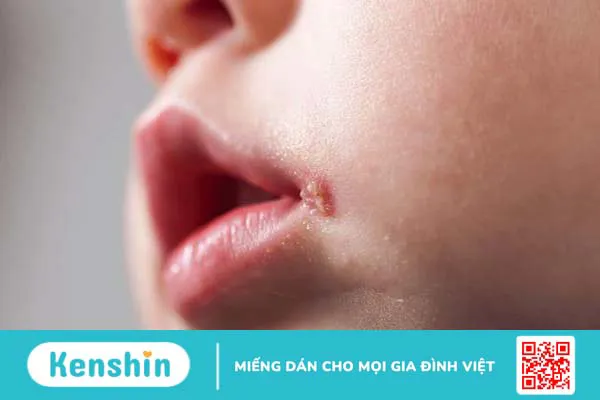 Viêm mép môi là bệnh gì? Cách điều trị như thế nào? 2