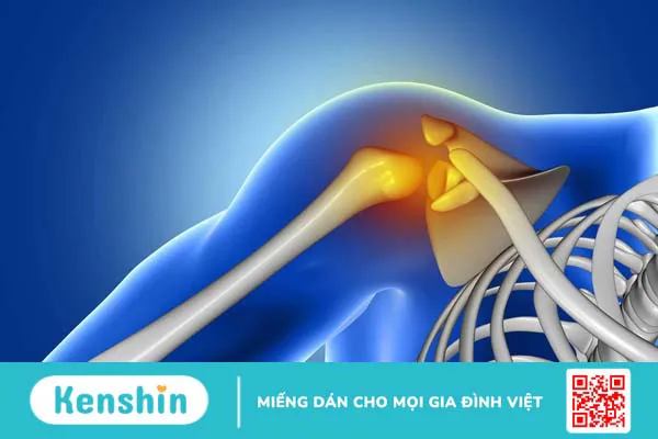 Viêm quanh khớp vai thể đông đặc là gì? Chẩn đoán và phương hướng điều trị 1