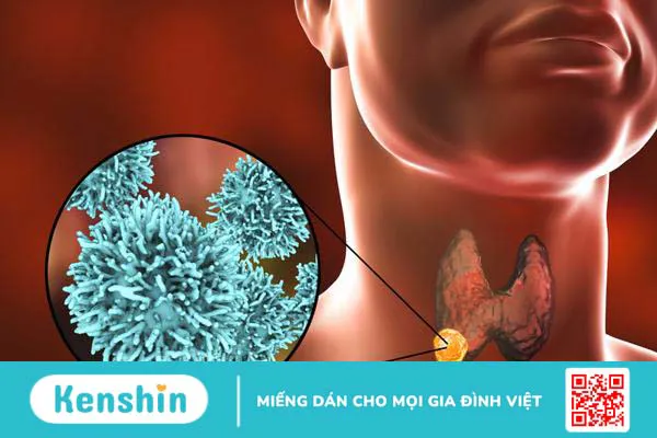 Viêm tuyến giáp sinh mủ: Tìm hiểu nguyên nhân và cách điều trị 1