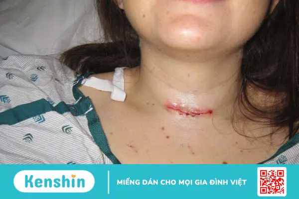 Viêm tuyến giáp sinh mủ: Tìm hiểu nguyên nhân và cách điều trị 3