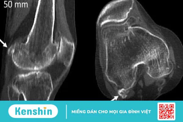 Viêm xương vừng và những điều cần biết về bệnh 1