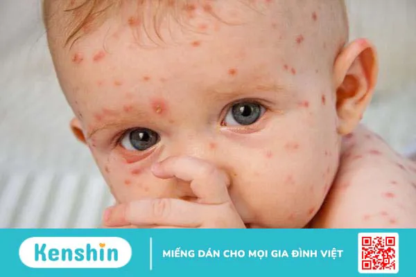 Virus thủy đậu sống bao lâu trong không khí? Hình thức dễ lây nhiễm của bệnh 3