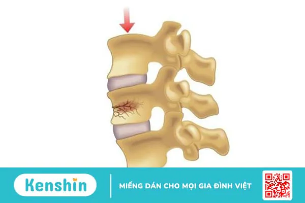 Xẹp đốt sống lưng D12 và những điều cần biết về bệnh 1