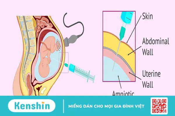 Xét nghiệm ADN trước sinh có chính xác không? 1