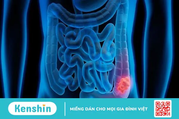 Xét nghiệm CEA - Phương pháp chẩn đoán các bệnh ung thư +2