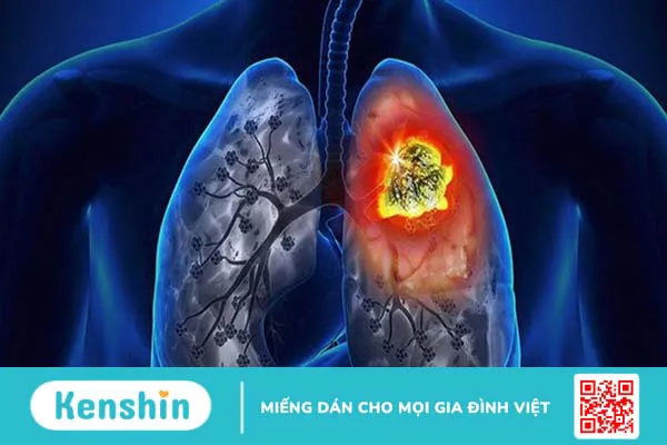 Xét nghiệm CEA - Phương pháp chẩn đoán các bệnh ung thư +3