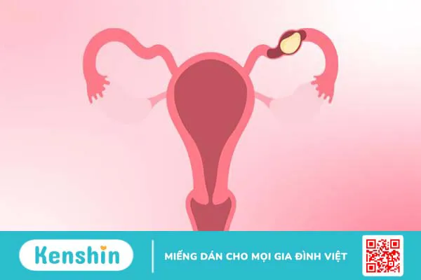 Xét nghiệm máu có thai nhưng siêu âm đầu dò không thấy là vì sao? Nguyên nhân và cách xử trí 3